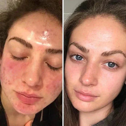 🏆#1 Best Selling🏆 Turmeric Kojic Acid Cleansing Pads